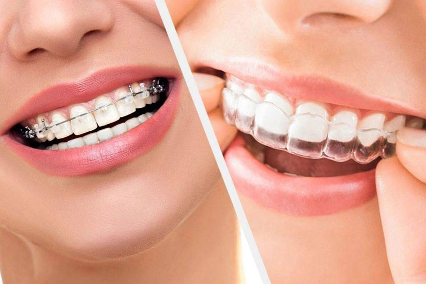 Braces vs. Clear Aligners: What's the Difference?